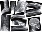 Broken Bones X-Rays